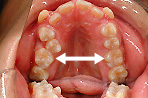 狭窄歯列の写真1