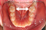 狭窄歯列の写真2