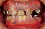 崩壊歯列の写真1