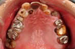 崩壊歯列の写真2