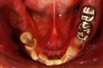 崩壊歯列の写真3