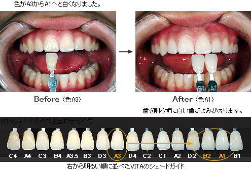 [上の画像]色がA3からA1へと白くなりました。歯を削らずに白い歯がよみがえります。[下の画像]右から明るい順に並べたVITAのシェードガイド