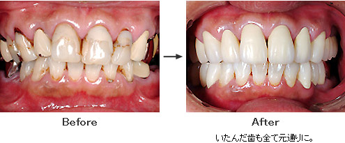 いたんだ歯も全て元通りに。