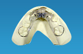混合歯列期に用いる主な装置 2