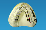 混合歯列期に用いる主な装置 3