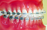 永久歯列に用いる主な装置 1