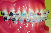 永久歯列に用いる主な装置 2