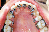 永久歯列に用いる主な装置 3