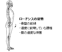 ロードシスの姿勢・骨盤の前傾・過度に前彎している腰椎・膝の過度な伸展