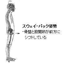 スウェイ・バック姿勢・骨盤と股関節が前方にシフトしている