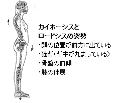 カイホーシスとロードシスの姿勢・頭の位置が前方に出ている・猫背（背中が丸まっている）・骨盤の前傾・膝の伸展 
