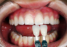 松崎ファミリー歯科矯正歯科 > 審美歯科 > 治療の種類