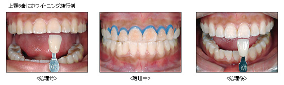 上顎6歯にホワイトニング施行例