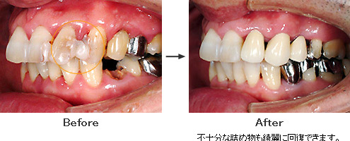 不十分な詰め物も綺麗に回復できます。