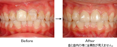 歯と歯肉の境に金属色が見えません。