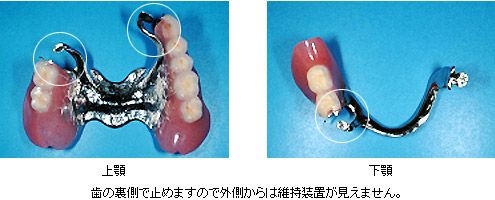 歯の裏側で止めますので外側からは維持装置が見えません。