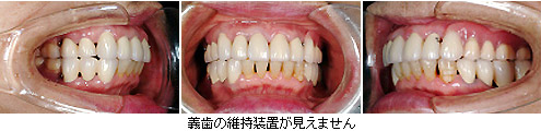 義歯の維持装置が見えません