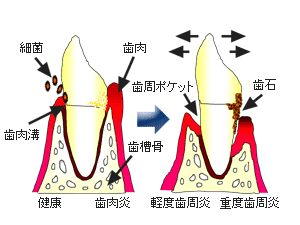 歯周病の仕組み