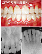 歯肉炎患者の歯