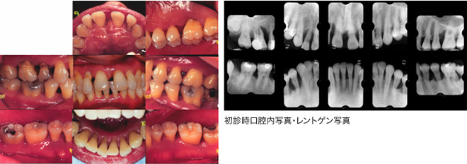 初診時口腔内写真・レントゲン写真