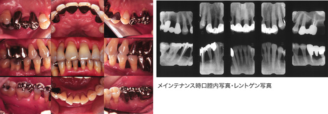 メンテナンス時口腔内写真・レントゲン写真