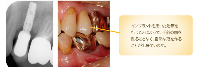 インプラントを用いた治療を行うことによって、手前の歯を削ることなく、自然な冠を作ることが出来ています。