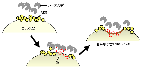 虫歯の仕組み