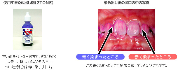 歯垢の染め出し方法