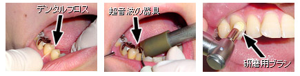 歯垢除去の写真